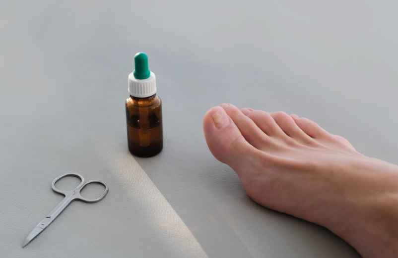 Les traitements sans ordonnance contre la mycose