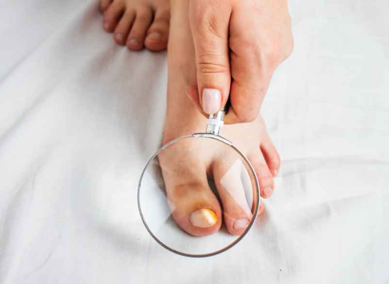 Quel traitement de la mycose du pied sans ordonnance ?